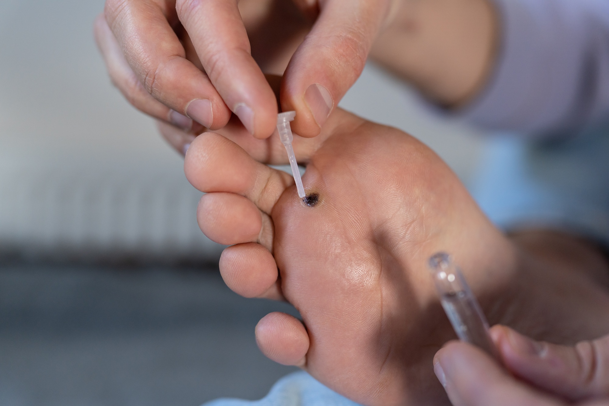 Alternative home treatment of verruca foot. Man applying liquid celandine extract on wart plantar.