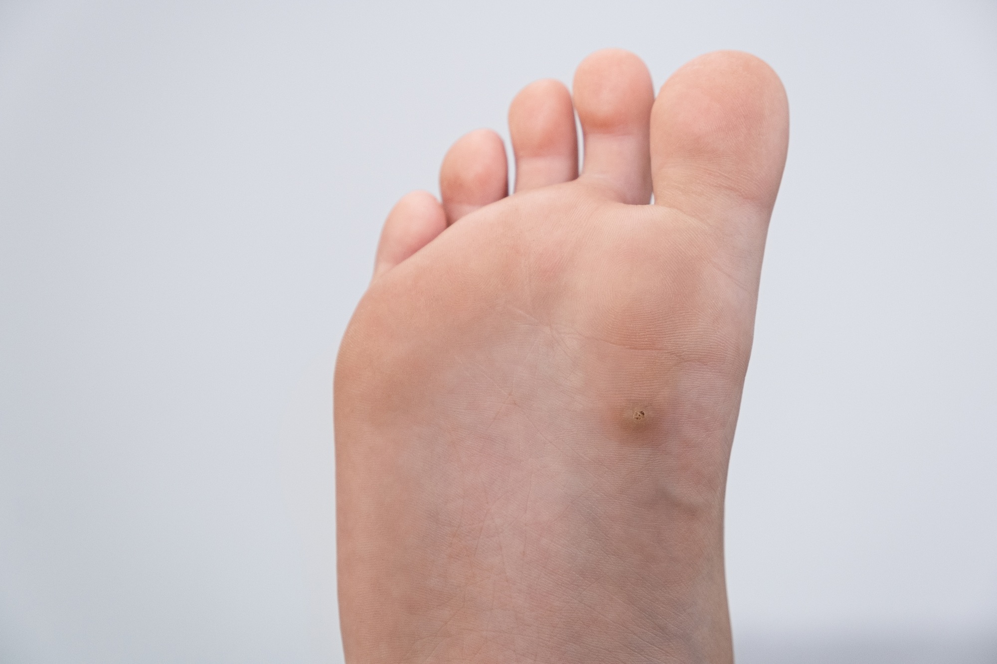 wart, papilloma on a feet. Macro shot, selective focus, close-up, space for text. Dermatological